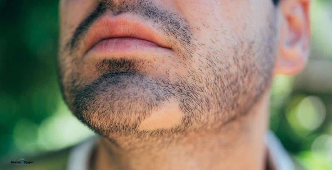 Alopecija Arata
