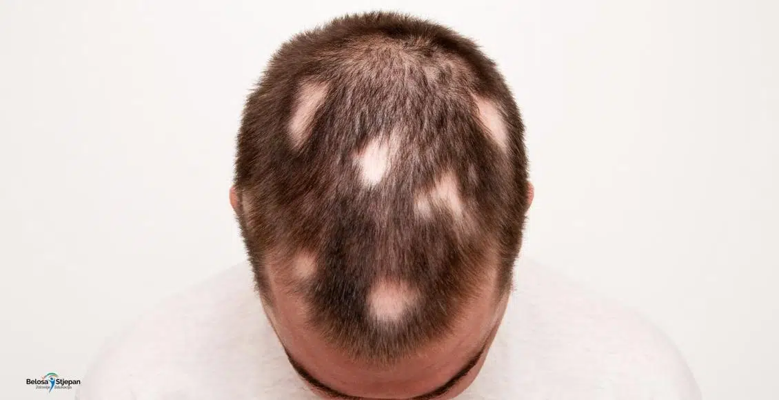 Alopecija Areata